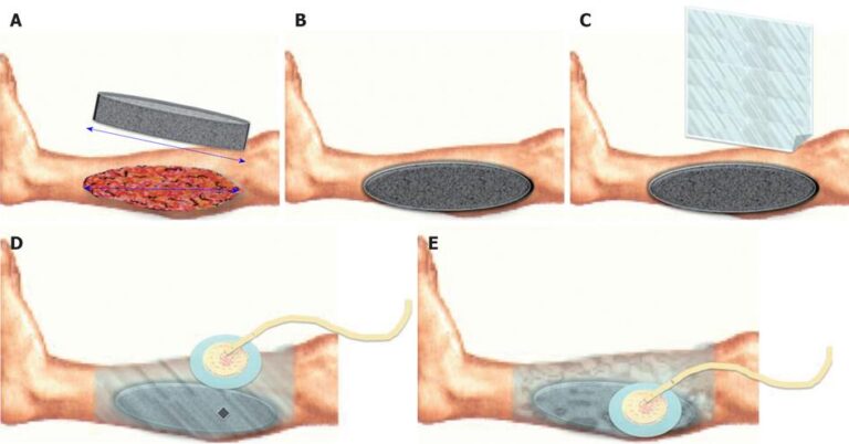 vacuum-assisted-closure-of-a-wound-vac-therapy-dr-anushtup-de