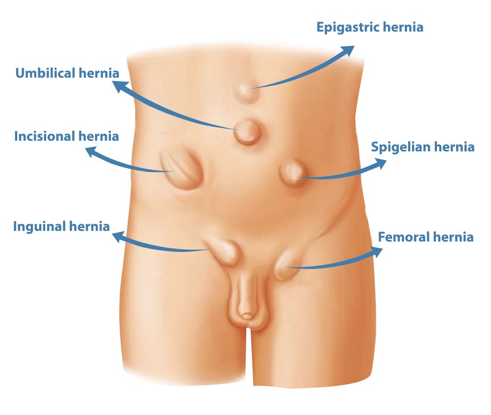 Hernia Surgery - Dr Anushtup De